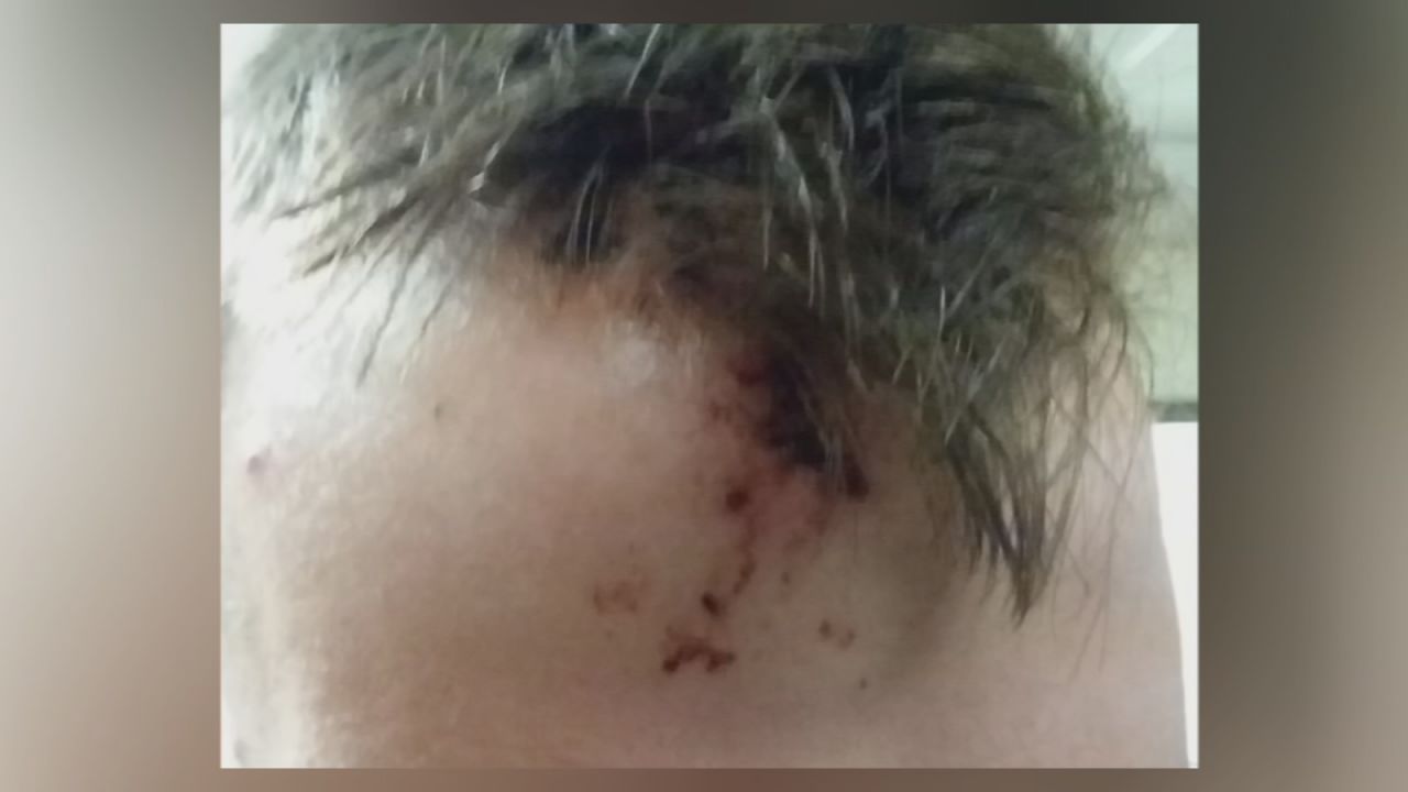 Morgenn Evans Forehead grazed